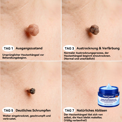 👨‍⚕️Natravor® 𝟕-𝐓𝐚𝐠𝐞 𝐇𝐚𝐮𝐭𝐚𝐧𝐡ä𝐧𝐠𝐬𝐞𝐥- & 𝐅𝐥𝐞𝐜𝐤𝐞𝐧-𝐄𝐧𝐭𝐟𝐞𝐫𝐧𝐮𝐧𝐠𝐬𝐜𝐫𝐞𝐦𝐞 (𝐒𝐜𝐡𝐦𝐞𝐫𝐳𝐟𝐫𝐞𝐢𝐞 𝐅𝐨𝐫𝐦𝐞𝐥 – 𝐨𝐡𝐧𝐞 𝐍𝐚𝐫𝐛𝐞𝐧)