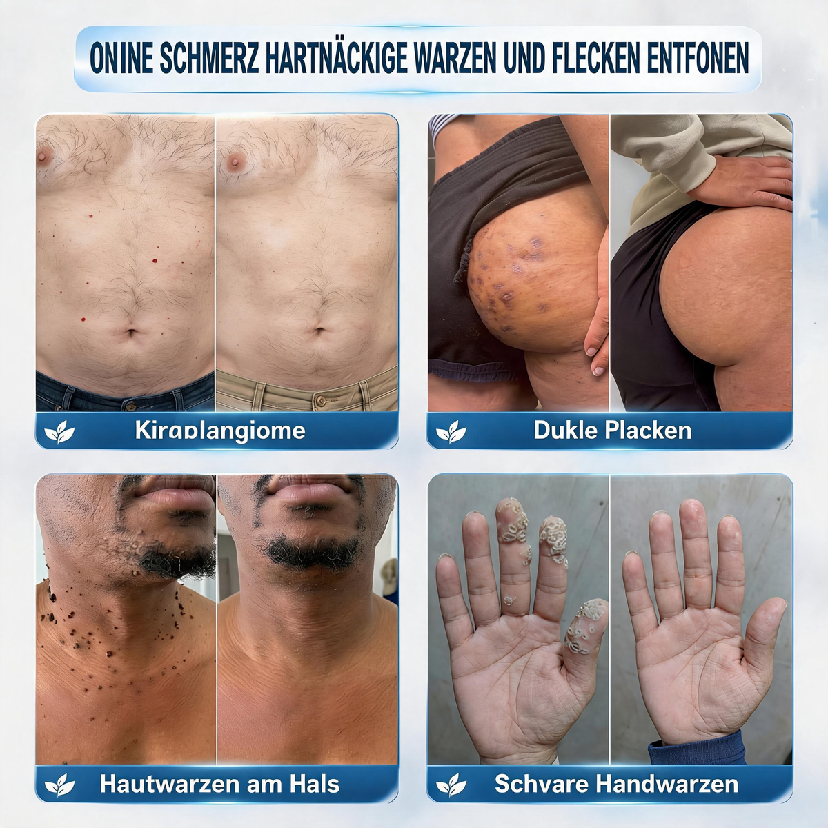 👨‍⚕️Natravor® 𝟕-𝐓𝐚𝐠𝐞 𝐇𝐚𝐮𝐭𝐚𝐧𝐡ä𝐧𝐠𝐬𝐞𝐥- & 𝐅𝐥𝐞𝐜𝐤𝐞𝐧-𝐄𝐧𝐭𝐟𝐞𝐫𝐧𝐮𝐧𝐠𝐬𝐜𝐫𝐞𝐦𝐞 (𝐒𝐜𝐡𝐦𝐞𝐫𝐳𝐟𝐫𝐞𝐢𝐞 𝐅𝐨𝐫𝐦𝐞𝐥 – 𝐨𝐡𝐧𝐞 𝐍𝐚𝐫𝐛𝐞𝐧)