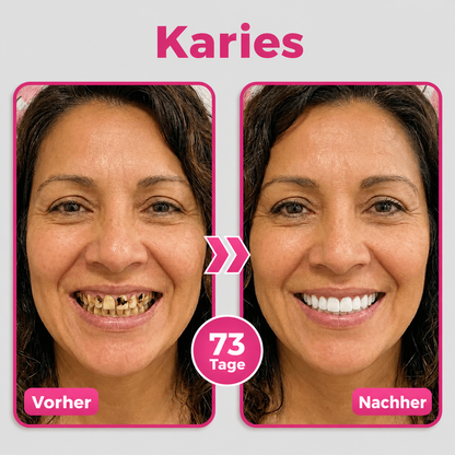 Natravor® Thismile NH-10 Zahnpasta-Serum für Zahnschmelz und Zahnfleisch – Advanced Therapy